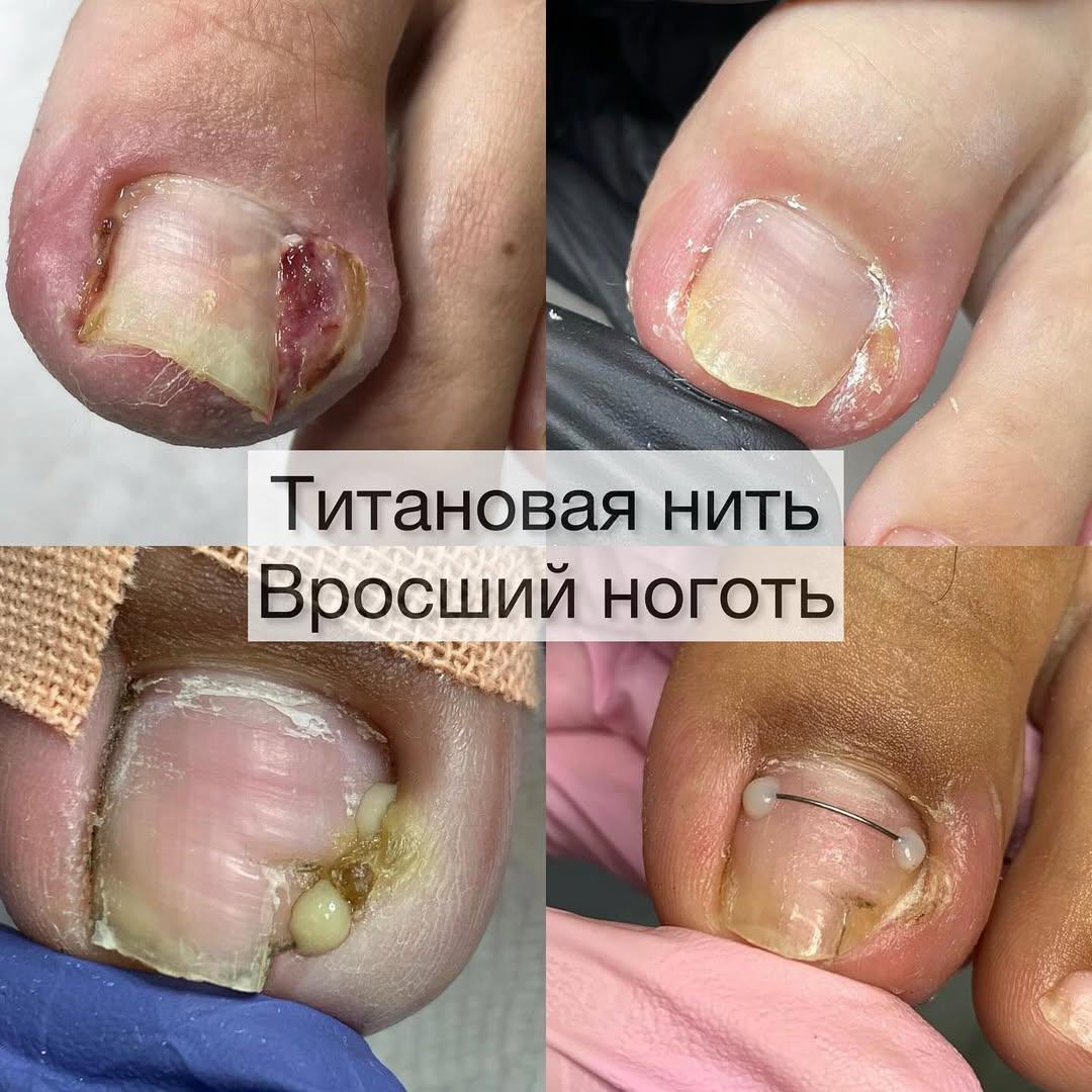 gribok_nogtey