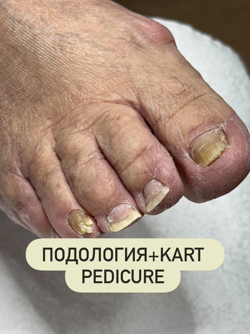 Подология + KART Pedicure